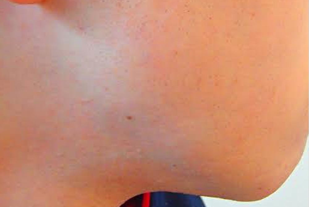 ほほひげ脱毛After