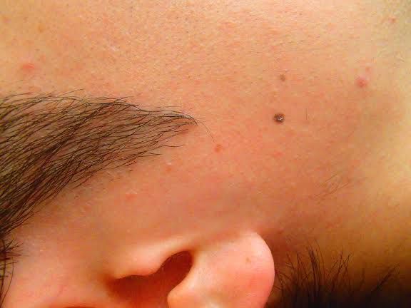 もみあげ脱毛After