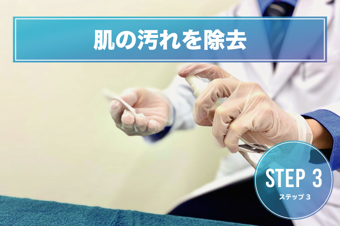 手の甲脱毛Step3